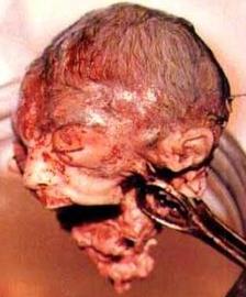 Thumbnail image for aborted baby head.jpg